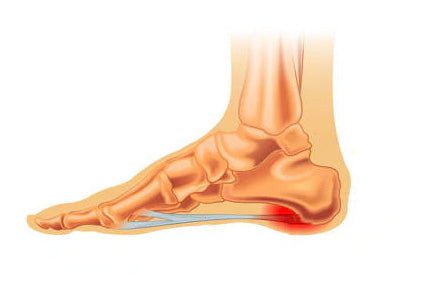 A Comprehensive Review of the Best Shoes for Plantar Fasciitis